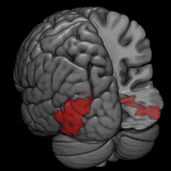 3D representation of a brain with red splotches indicating activity